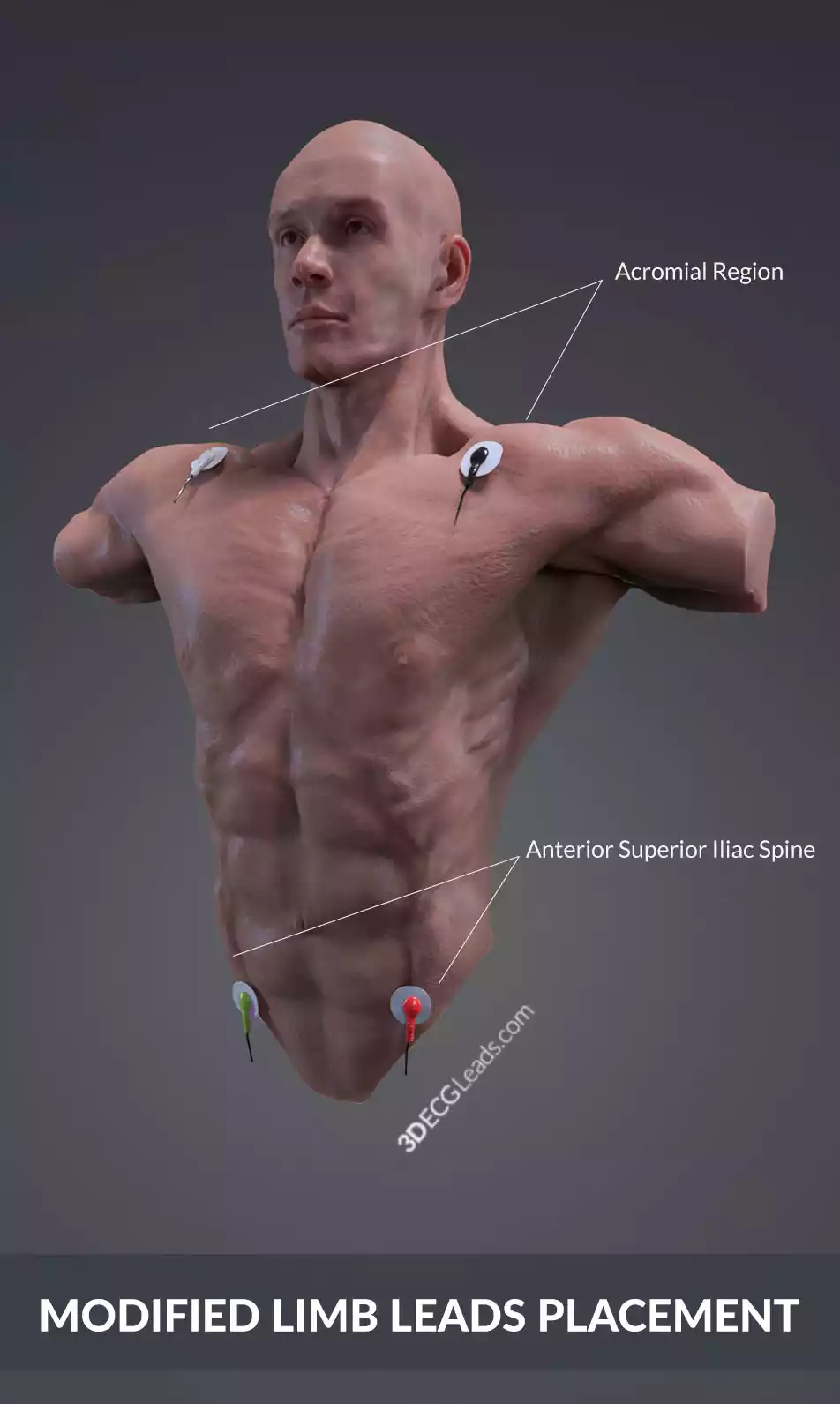 limb lead reversal ecg